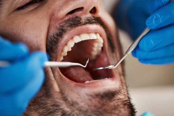 Best Emergency Wisdom Tooth Extraction in Thonotosassa, FL